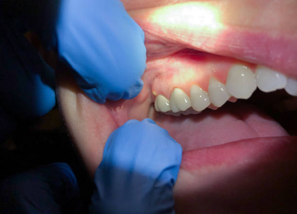 Best Dental Abscess Treatment in Wetumpka, AL